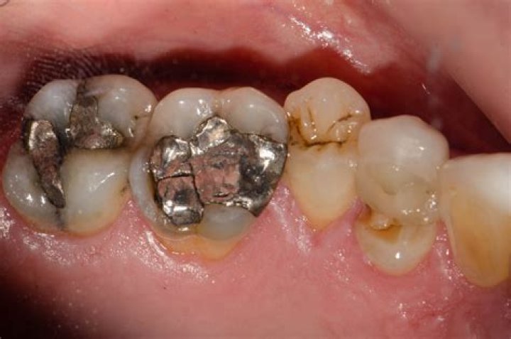 What is the cusp on a tooth