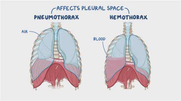 What is the difference between a pneumothorax and a Hemothorax