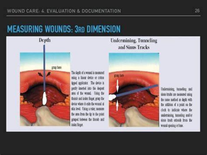 What is the difference between undermining and tunneling