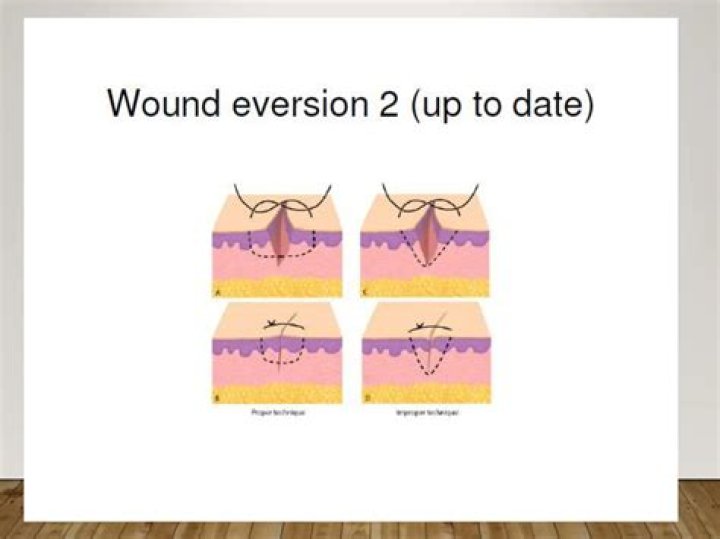 What is wound eversion
