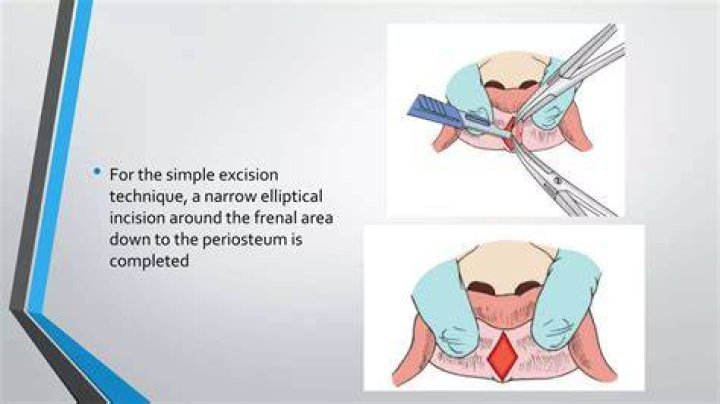 When should a Frenectomy be done