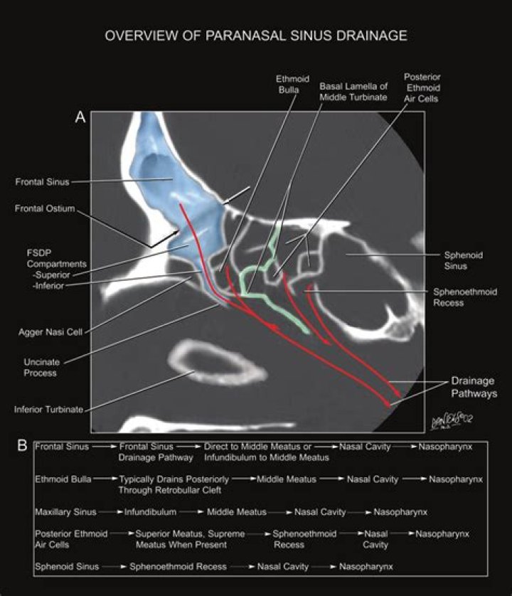 Where does the Sphenoethmoidal recess drain