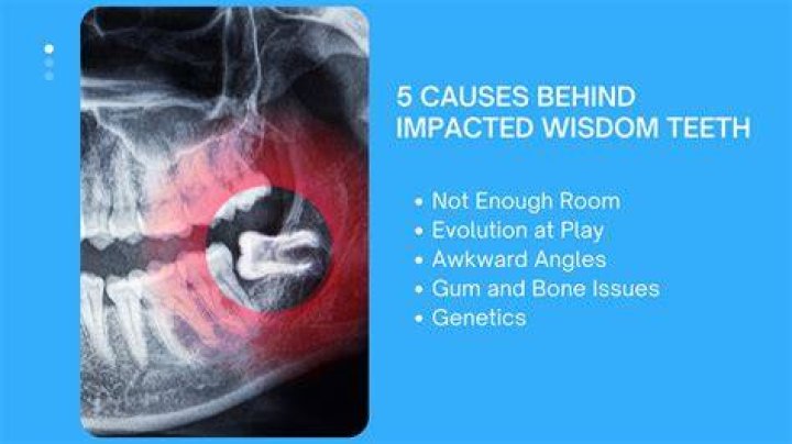 Who does surgery on wisdom teeth