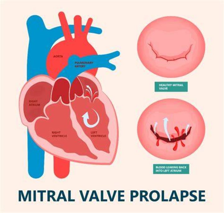Why does mitral valve prolapse murmur increases with Valsalva