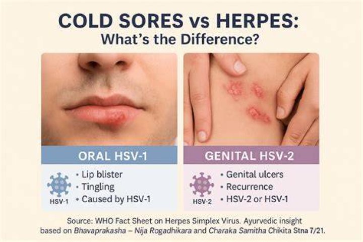 Why is herpes considered an STD