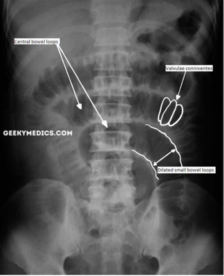 Will abdominal xray show bowel obstruction